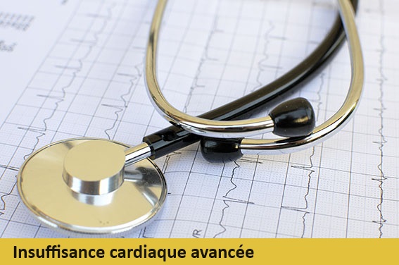 Illustration DIU Insuffisance cardiaque avancée